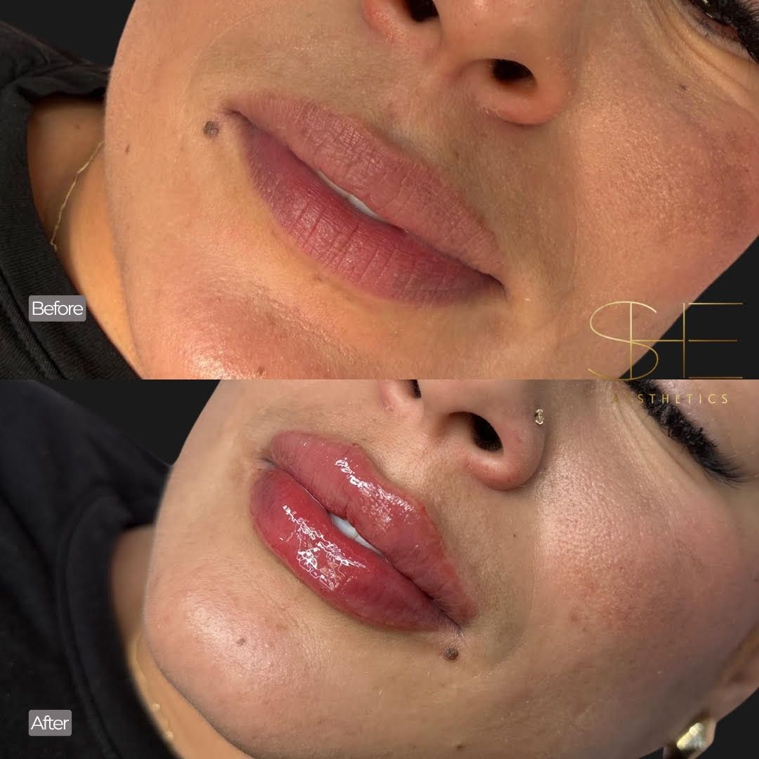 Amazing lip filler results at she aesthetic in klein, spring, cypress, the woodland tx Amazing lip filler results at she aesthetic in klein, spring, cypress, the woodland tx