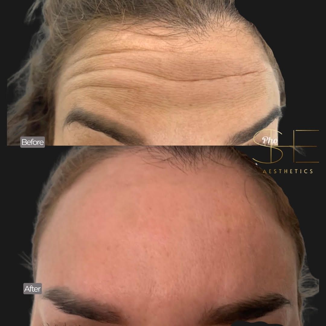 Smooth your wrinkles using botox at she aesthetics in klein, spring, the woodlands, cypress tx Smooth your wrinkles using botox at she aesthetics in klein, spring, the woodlands, cypress tx