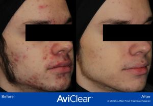 AviClear before and after