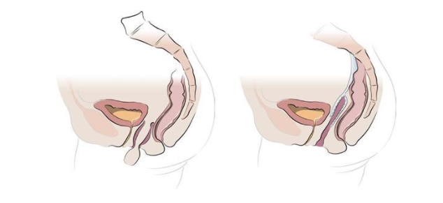 Illustration of how the robotic surgery works