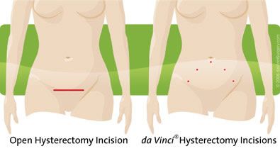 pic-robotic-hysterectomy.jpg
