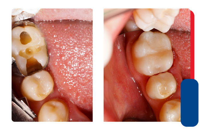 image of resin restoration