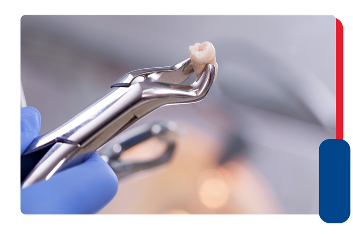 image of  tooth extraction