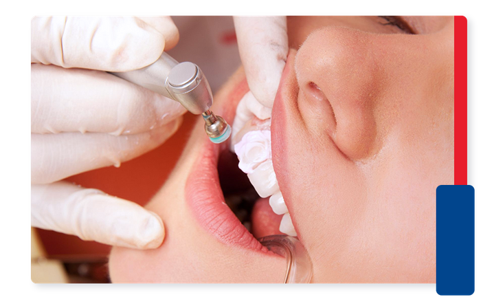 Person getting dental bonding on chipped tooth