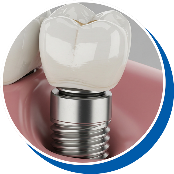 Dental Implants 1.png