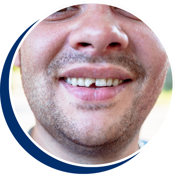 a man with a chipped tooth Emergency Dentistry Services Redesign (3).png