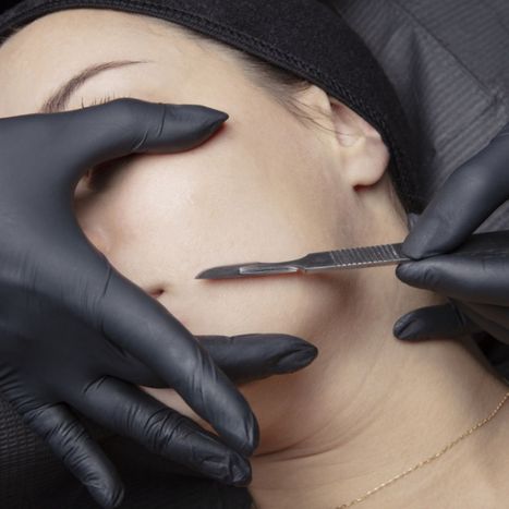 An image of a woman getting a dermaplaning treatment.
