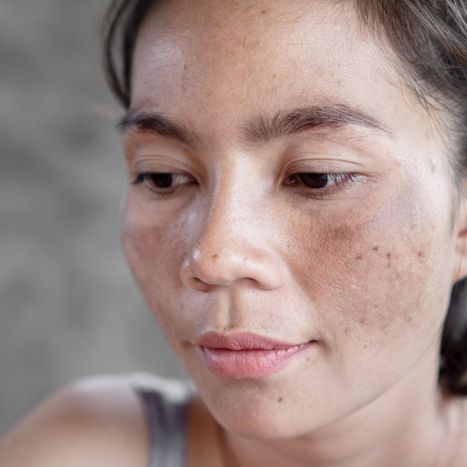 woman with sun damaged skin