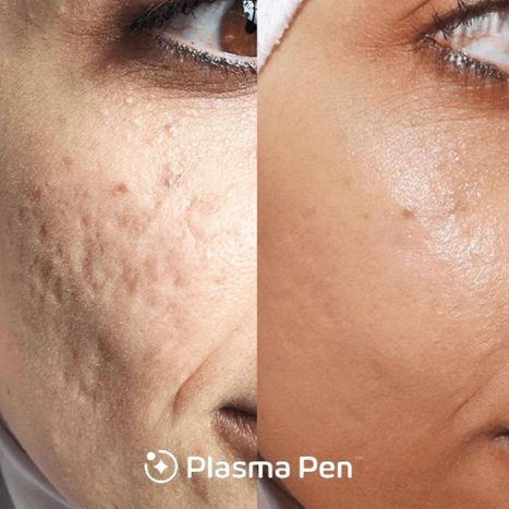 a before and after of a plasma pen treatment on a face