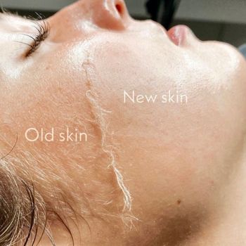 An image of skin before and after dermaplaning.
