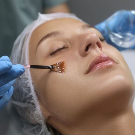 Putting a chemical peel on