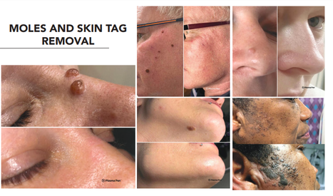 Moles & Skin Tag Removal.png