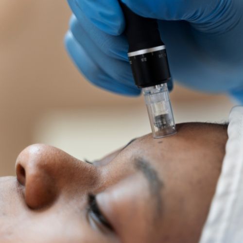 MICRONEEDLING