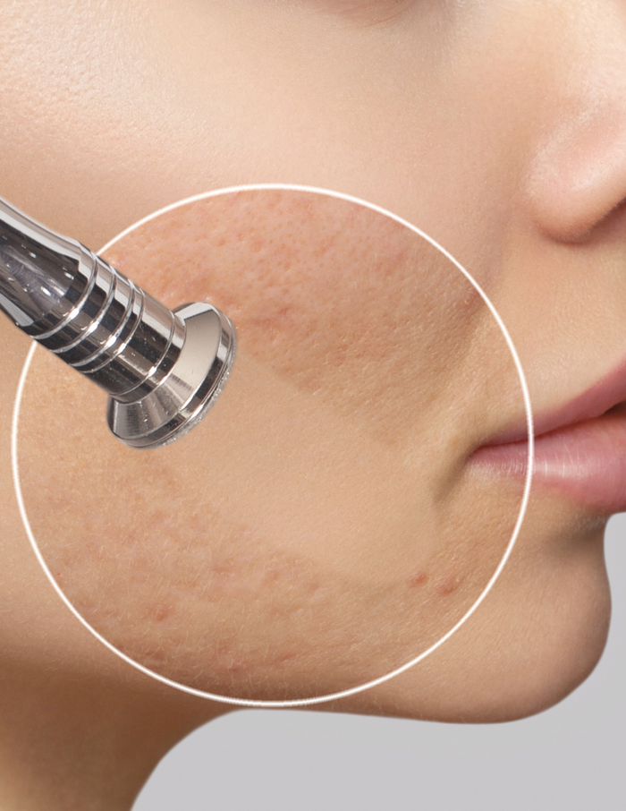 Microdermabrasion Pic.png