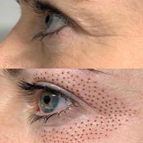 before and after eye treatment