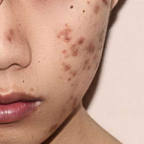 woman with acne scarring