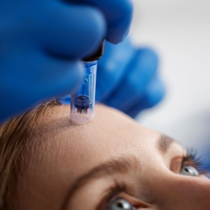 image of microneedling