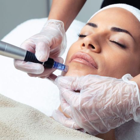 The Benefits of Microneedling - Image 1.jpg