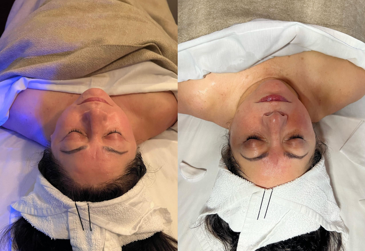 1 CryoFacial - Karmeles Esthetics.png