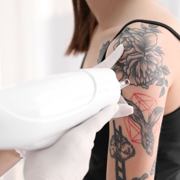 colored tattoo removal