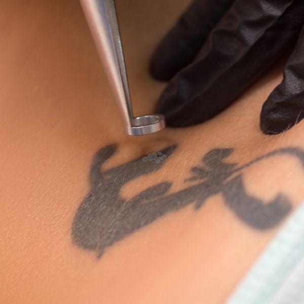 Tattoo removal