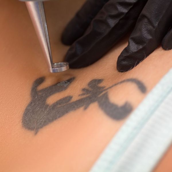 effects of laser tattoo removal on shoulder