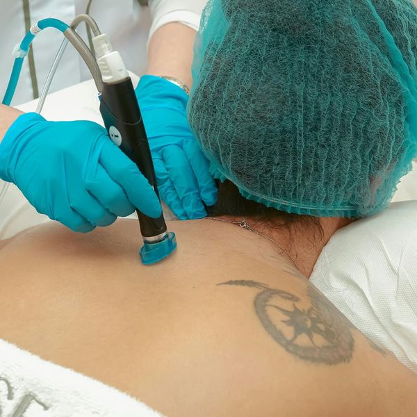 tattoo removal on bak