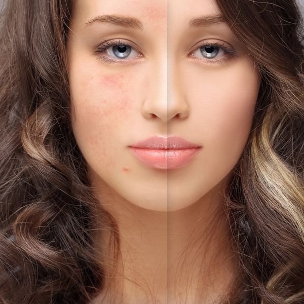 before and after acne laser treatment