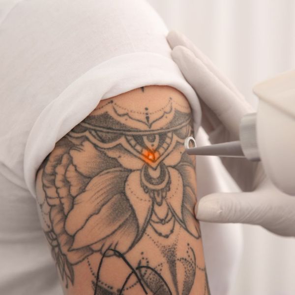 removing a tattoo with a laser 