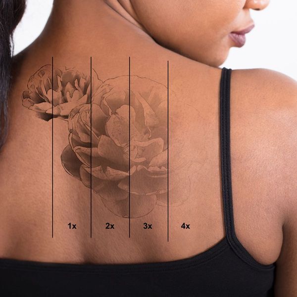 Tattoo Removal Consultation (4).jpg