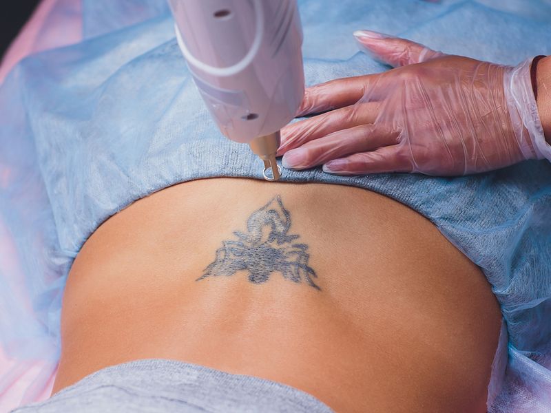 Laser Tattoo Removal  Dr Kara Plastic Surgery