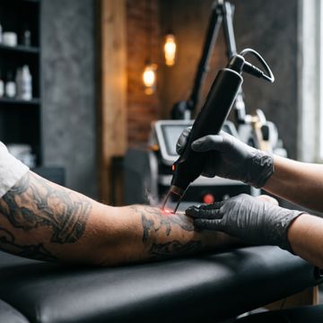tattoo removal