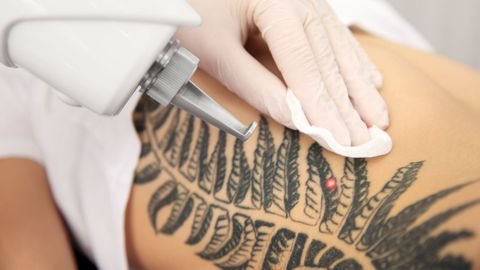 M24620 - Moran Laser and Spa - 4 Side Effects of Laser Tattoo Removal.jpg