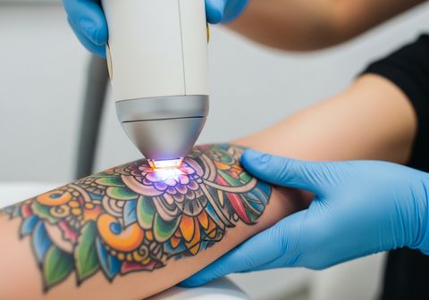 Close-up of a colorful mandala tattoo on a person's arm undergoing laser removal. A technician wearing blue gloves holds a laser device emitting a bright light, targeting the tattoo ink. Tattoo Removal Process