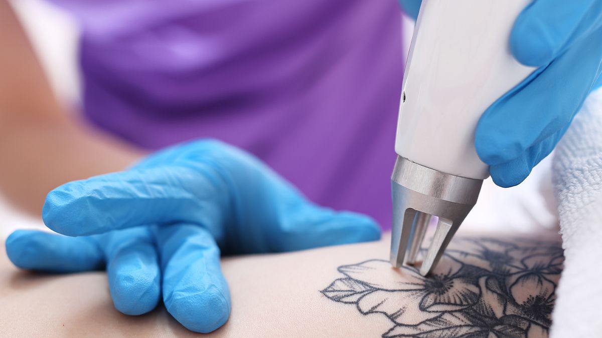 laserremoval.jpg