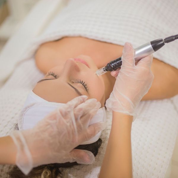 woman getting hair on her face removed with a laser