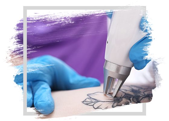 tattoo-removal-5c7570e821624.jpg