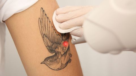 A Guide to Laser Tattoo Removal for Different Skin Tones.jpg