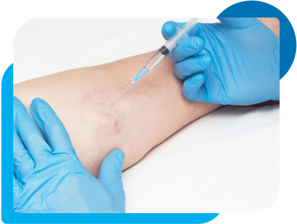 image of Sclerotherapy