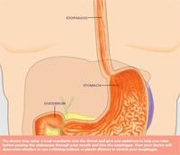 esophageal dilation image 1.jpg