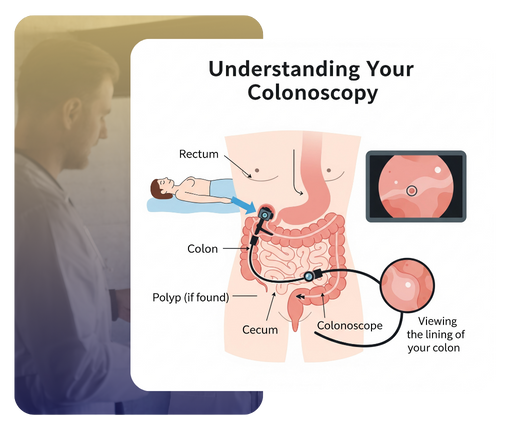 An easy-to-understand diagram showing how a colonoscopy is performed for a colon cancer screening.