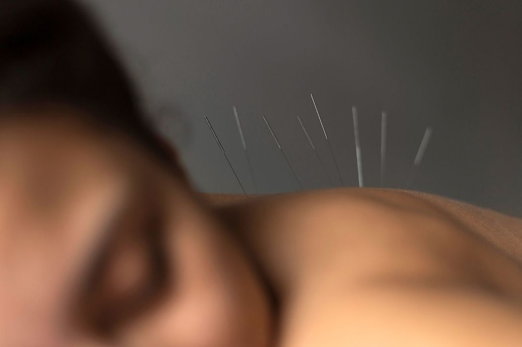 acupuncture (2).jpg