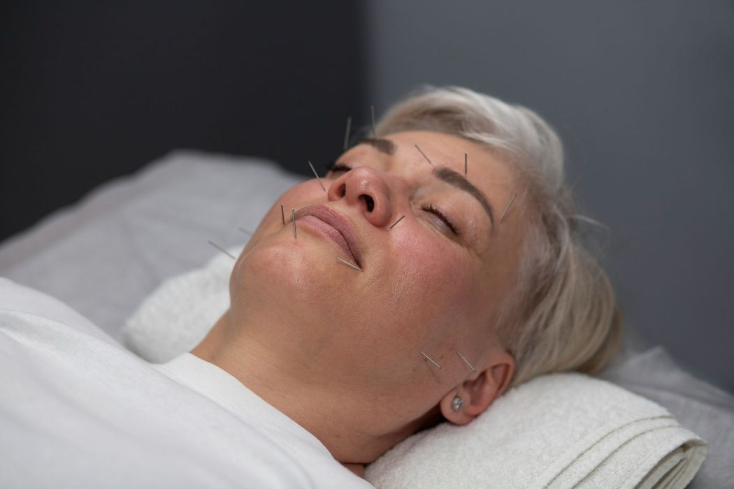 acupuncture-1.jpg
