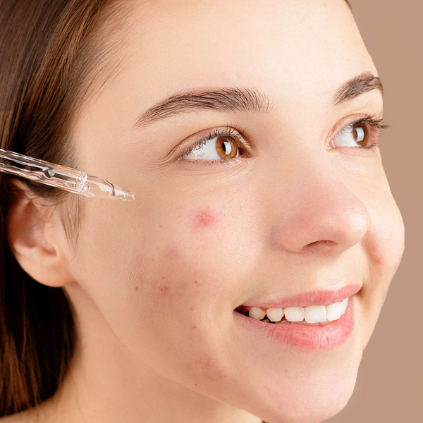 woman using acne product