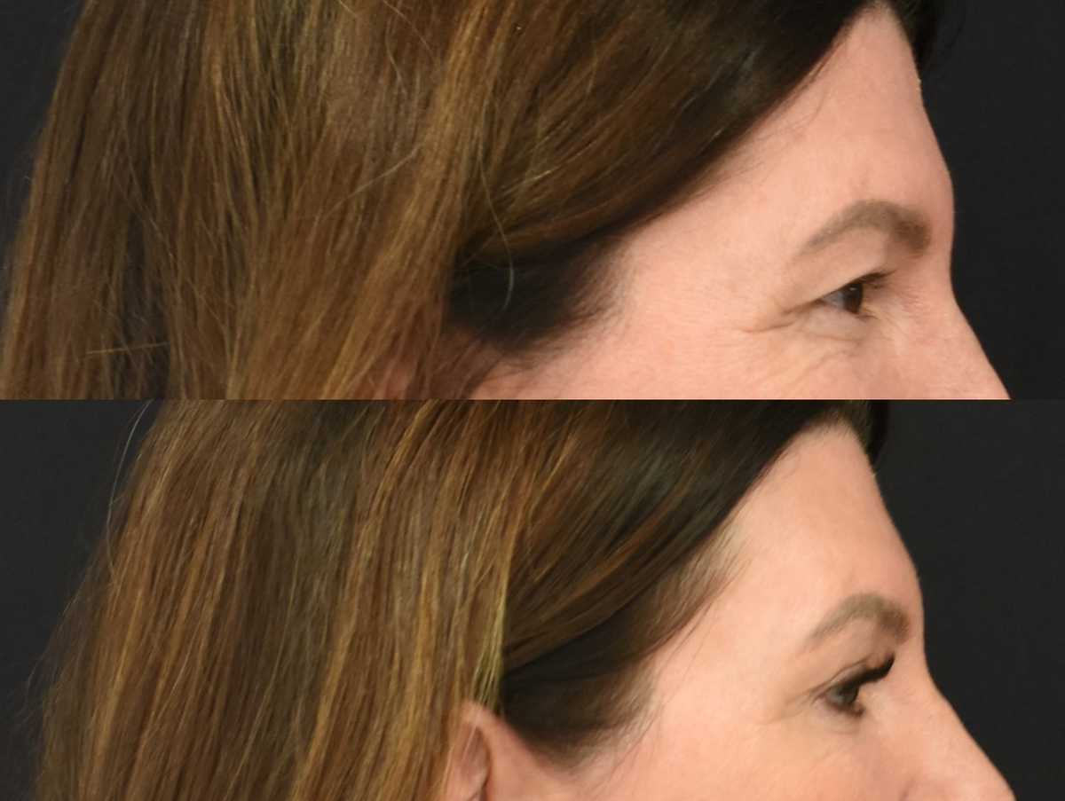 Brow Lift, Upper Eyelid Surgery (Blepharoplasty) Before & After in Cincinnati, Ohio