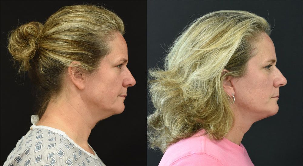 Facelift, neck lift, and lateral temporal brow lift recipient before & after image
