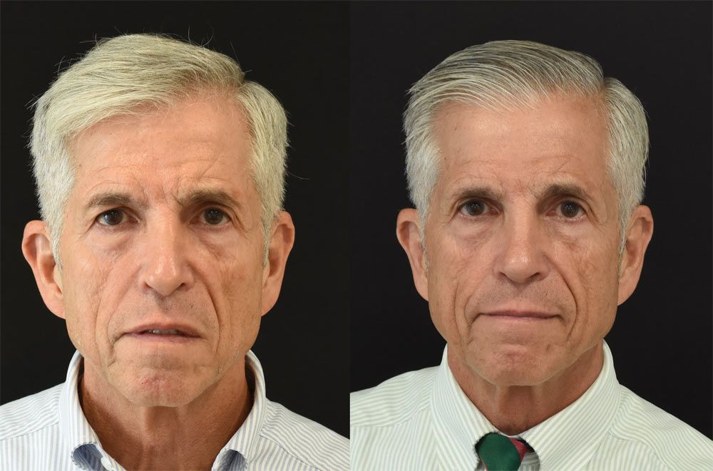 Cincinnati Revision Rhinoplasty Before & After - Optimized