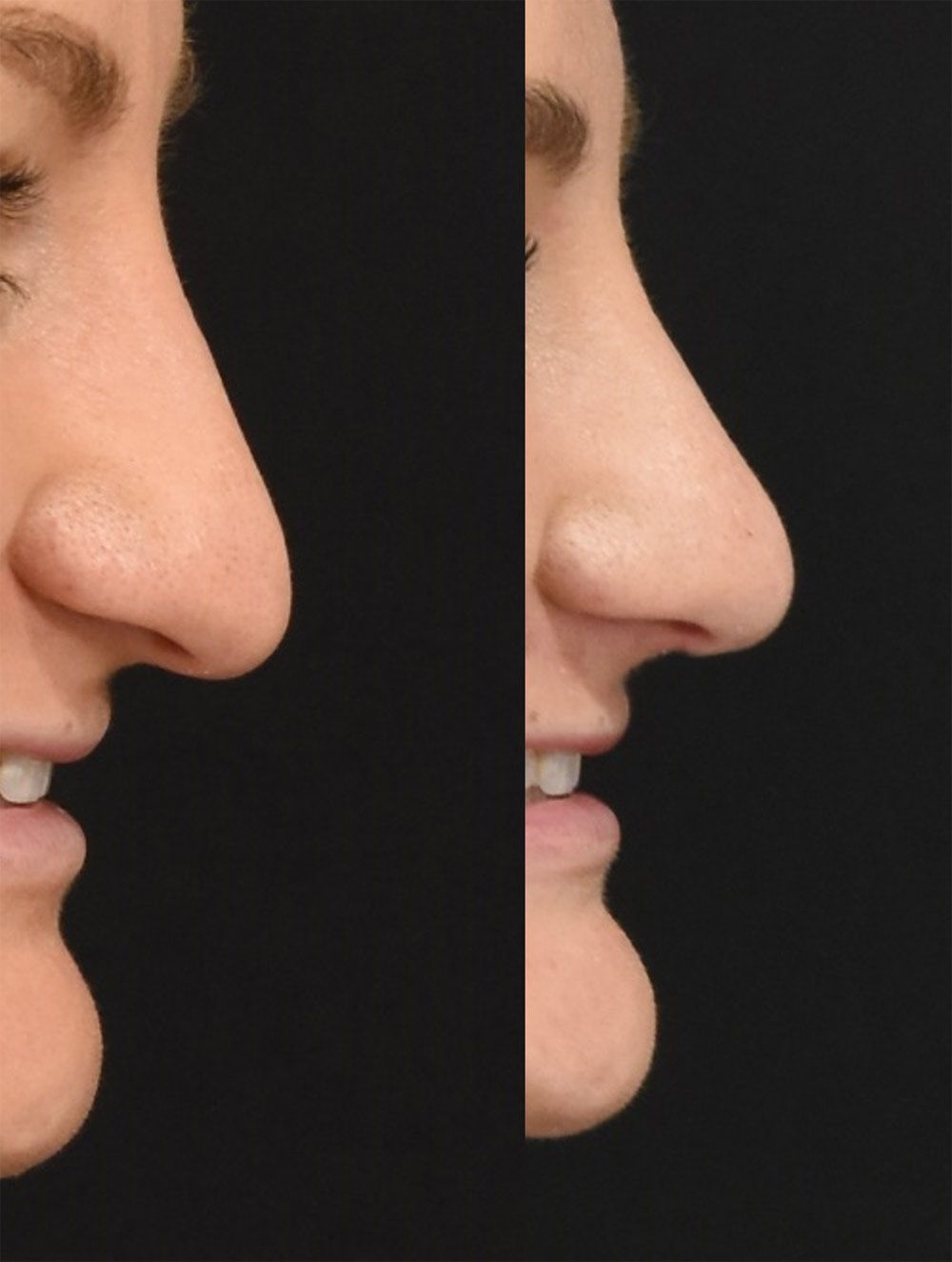 Rhinoplasty in Cincinnati