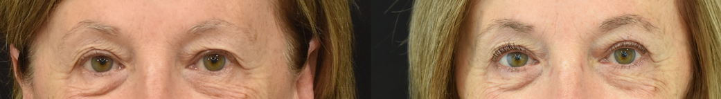 Upper eyelid (blepharoplasty) surgery before & after image in Cincinnati, Ohio