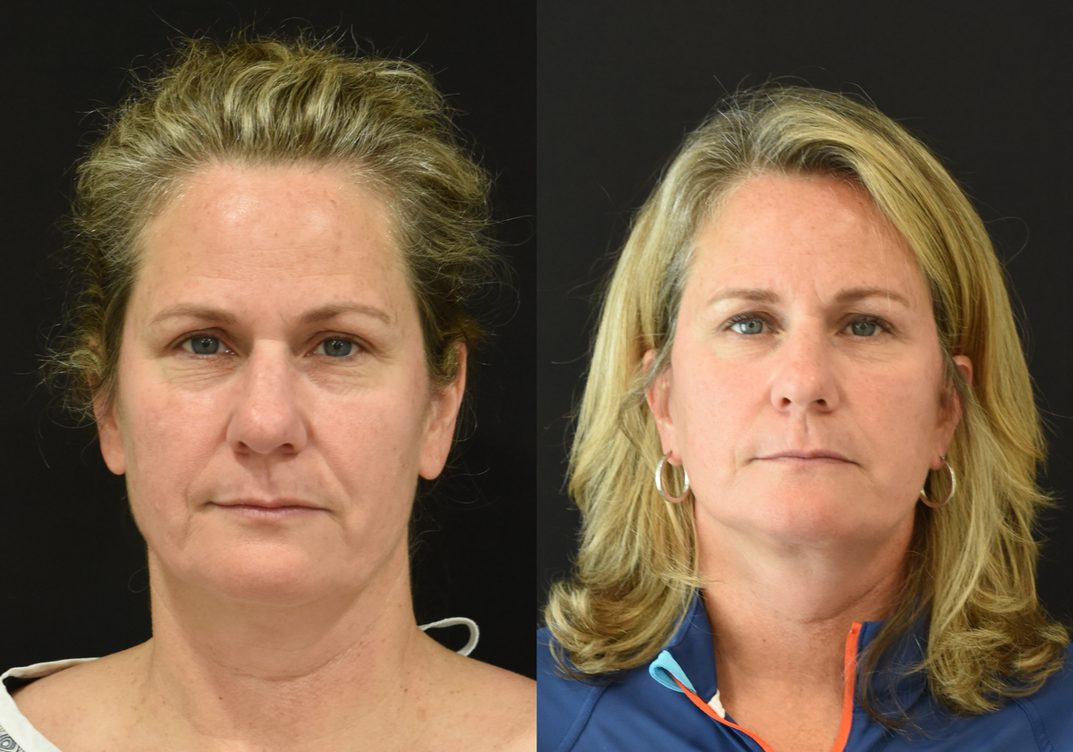 Facelift and Neck Lift in Cincinnati Before and After